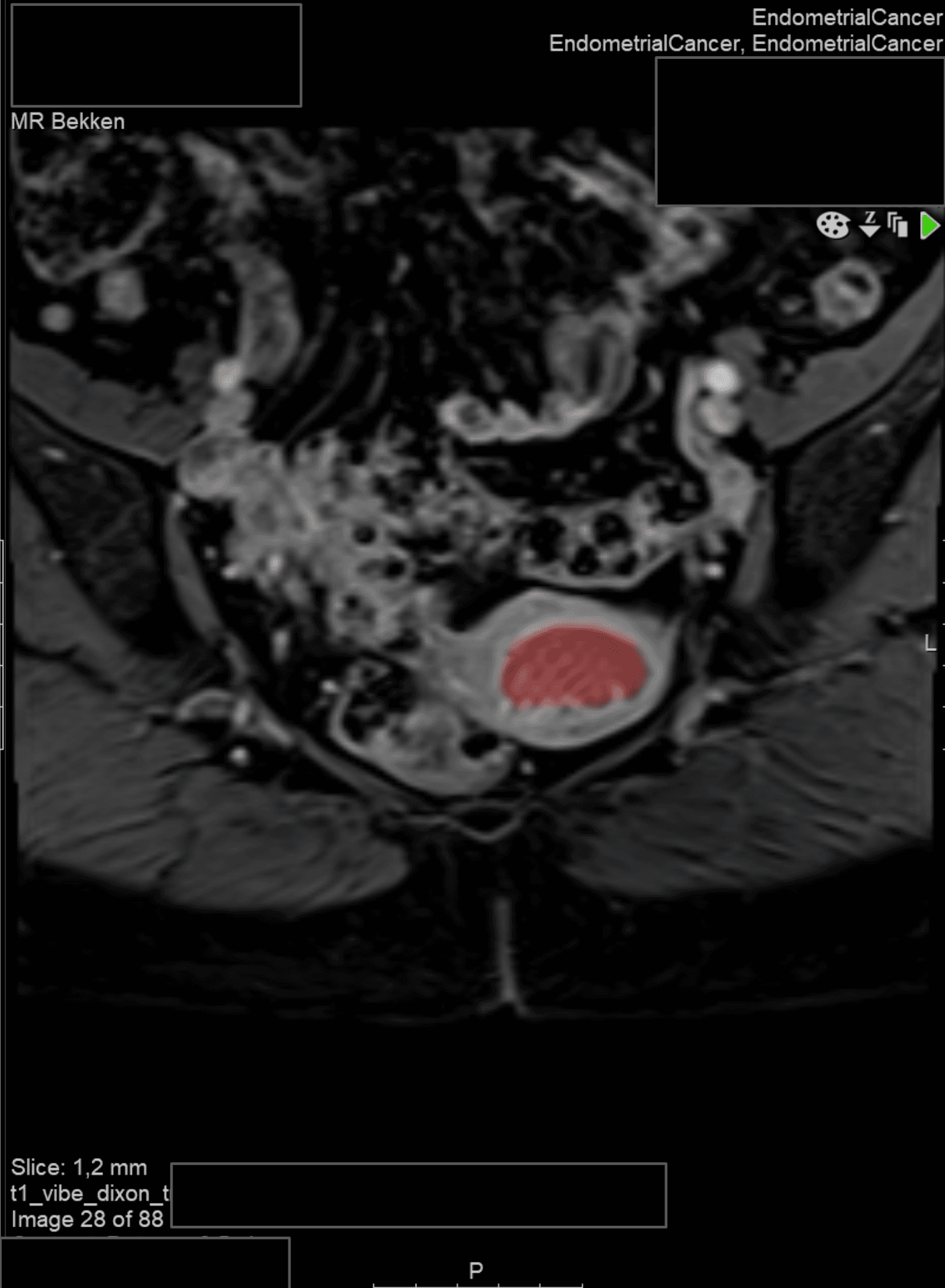 Endometrial Cancer Segmentation Model