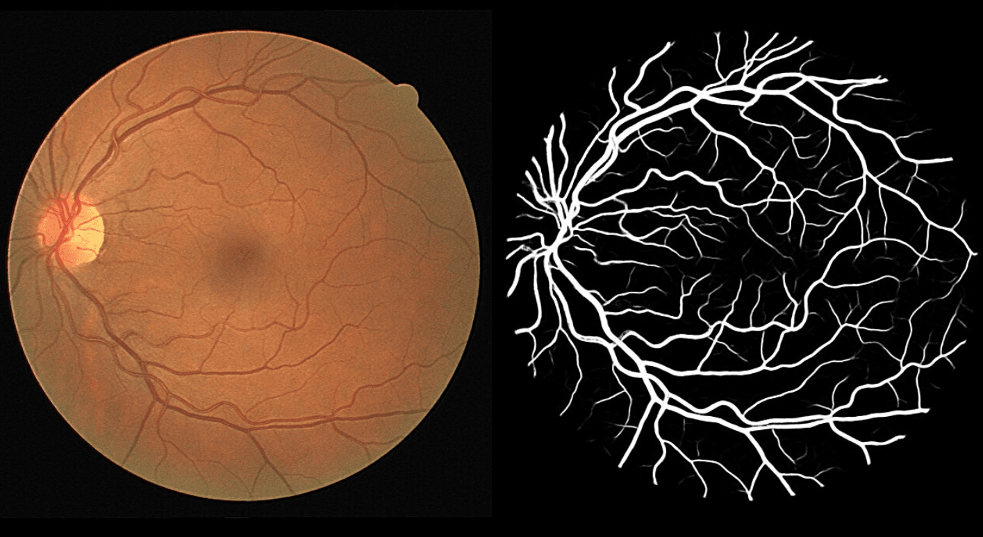 Retina Blood Vessel Segmentation