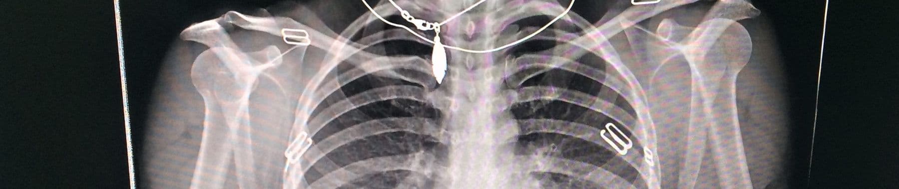 Chest X-ray Classification Demo Model