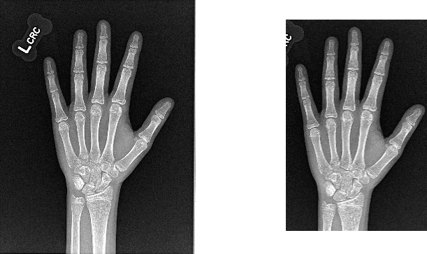 Bone Age Cropping Model